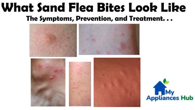 Sand Flea Bites (Jigger): Symptoms, Prevention, Treatment – Tungiasis